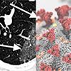 CT chest and coronavirus