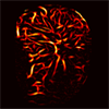 An image of a thyroid tumor, produced by high-definition microvasculature imaging, shows the tumor's microvasculature in high detail.