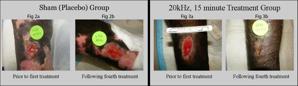 This image shows changes in the wound size of two venous ulcers either following four treatments of 20 kilohertz ultrasound for fifteen minutes a week or four treatments of a sham placebo treatment. The wound that received the therapeutic ultrasound is completely healed following the fourth treatment, whereas the placebo wound increased in size.